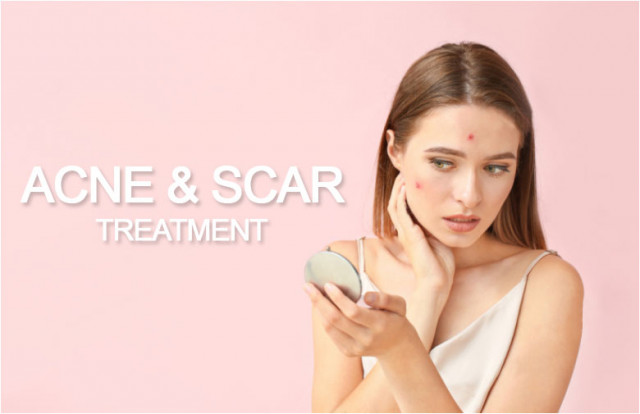 Acne & Scar Treatment in Kolkata