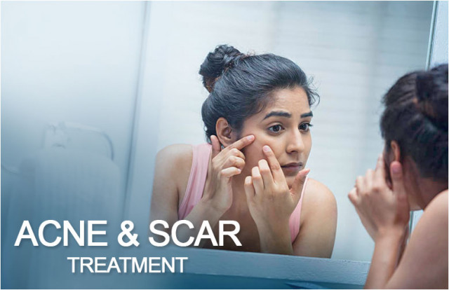 Acne & Scar Treatment in Kolkata