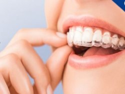 Teeth Straightening Aligners - Clear Teeth Straighteners 